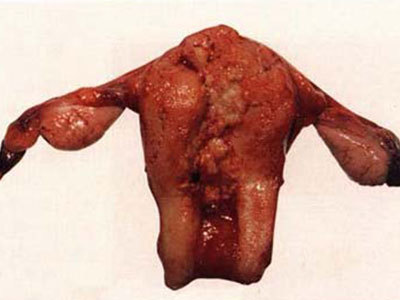 子宫体癌图片