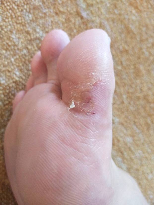 跖疣这是快好了吗?