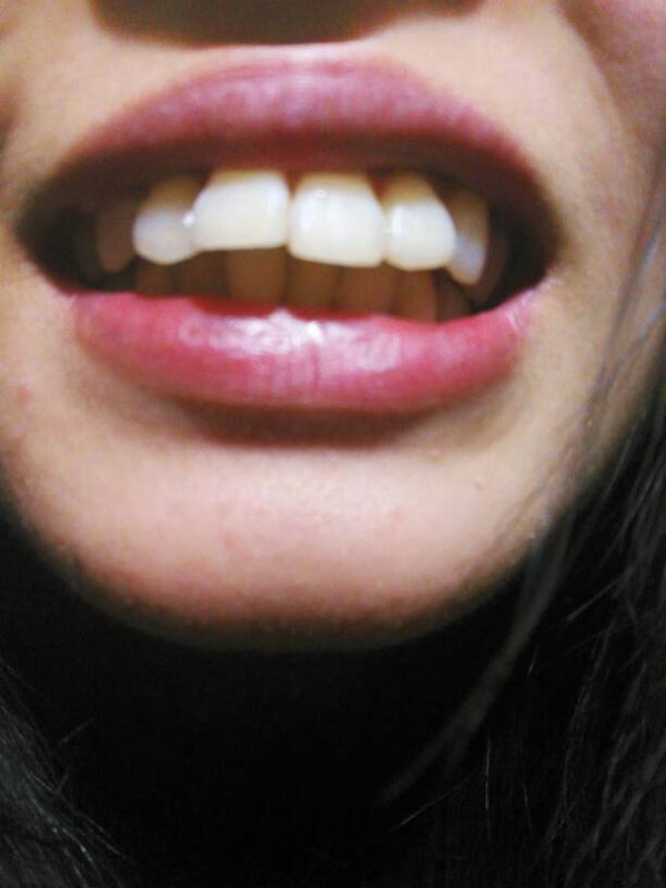 十三岁的时候做了牙齿矫正 拆了之后没有听医