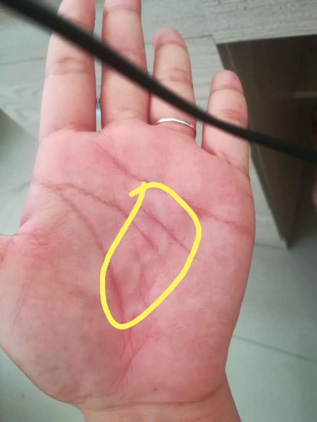手掌心痒是什么原因