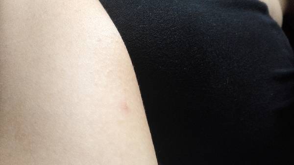 家人身上有好多红色的痒块,是跳蚤咬的还是什么?