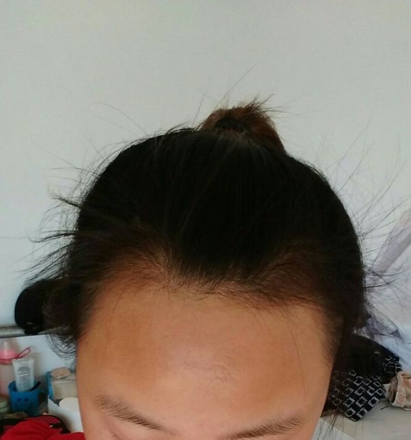 大家帮我看下我额头是哪种形状?高宽窄?