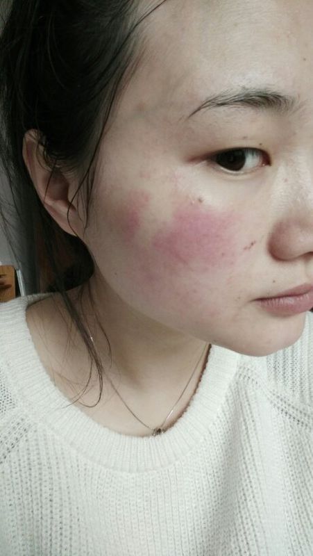 最近不知道是脸上过敏还是怎么回事,一开始脸上长疹子以为是经前激素
