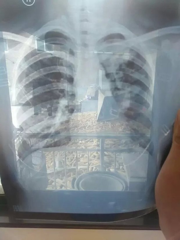 左肺上野及左肺内旁可见斑片状密度增高影余肺