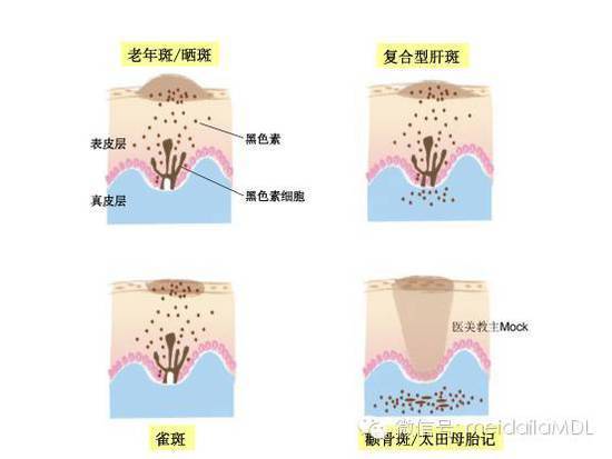 脸上长了斑 ,怎么区分是什么斑
