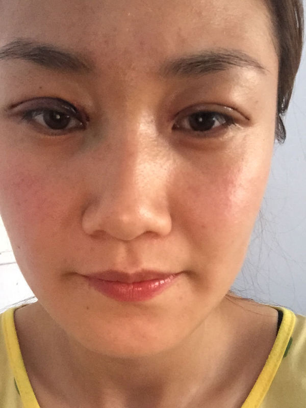 我的眼皮是内双肿眼泡抽的脂,做的埋线三点定