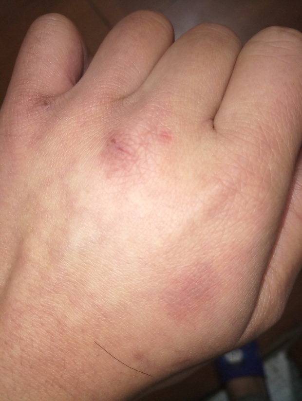 皮肤泛红,起皮怎么办?