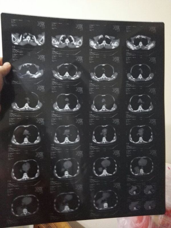 请各位名医帮忙看看64排CT扫描结果是肺癌的