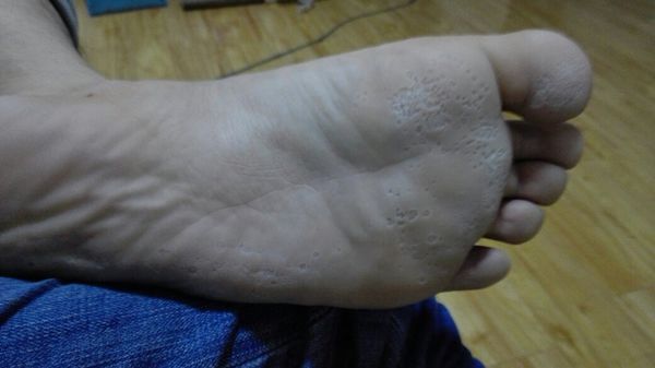 我的脚应该是生病了,每天洗完脚之后,脚底板发白,还有好多孔,臭死了