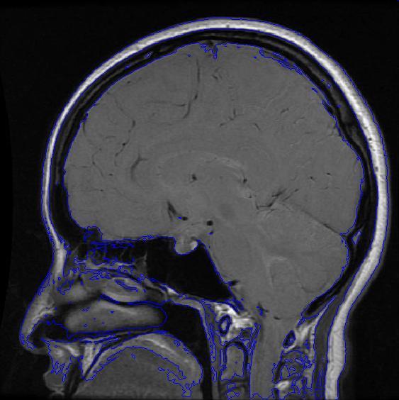 怎么用matlab实现MRI头部图分割后区域填充