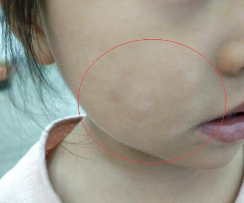 小孩脸上有白斑隐隐约约不注意看不明显