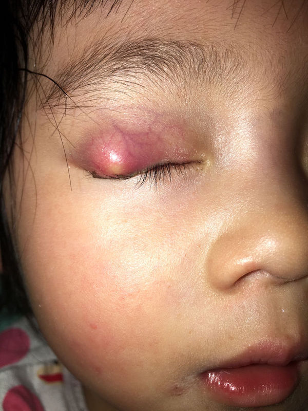 我女儿十六个月眼睛起了霰粒肿,肿的很大很红