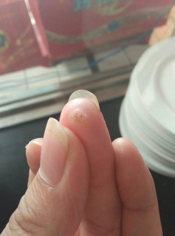 一条一条的.抱在手指的皮里面.一碰手指里面的肉就疼