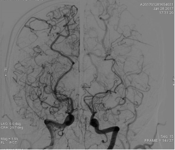 烟雾病脑血管造影图示