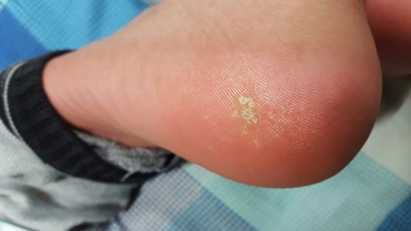 这个是鸡眼吗,长在脚后跟,摁上去有点疼,一直突出来的,以前拿刀切过一