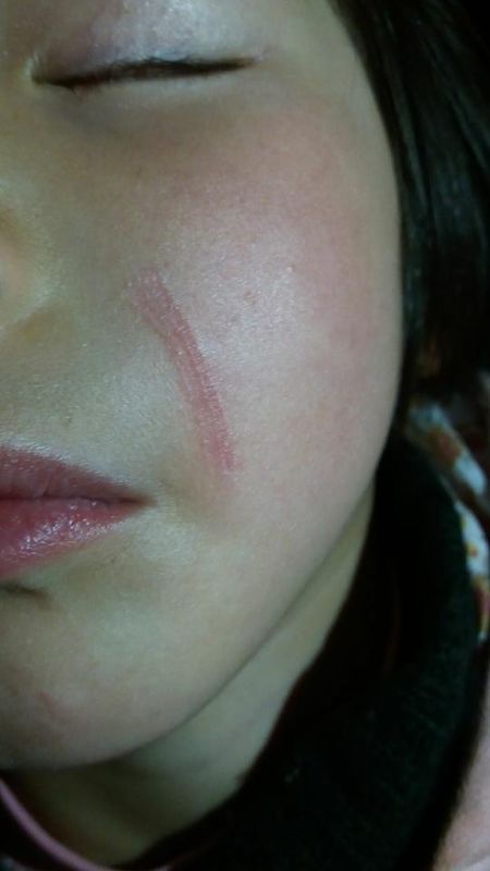 4岁的孩子脸上被树枝刮伤了,伤口也不是很深,