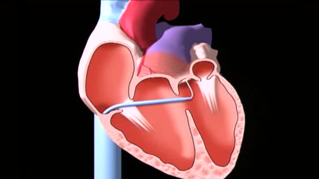 心臟搭橋手術在體內時如何工作的?3d動畫演示,很直觀很震撼