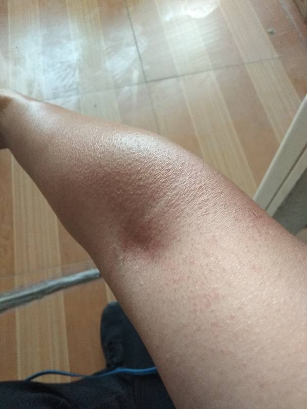 胳膊上好多小红疙瘩,有点痒怎么办?如何治疗?