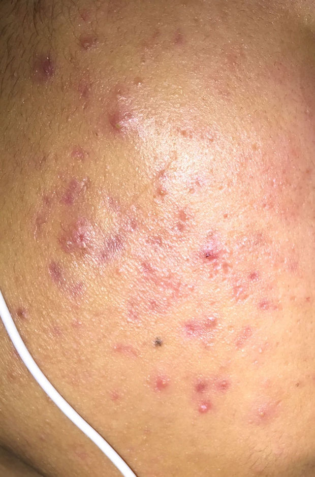 脸上都是脓包一样的痘痘和黑色的痘印,就像下面图片这样.