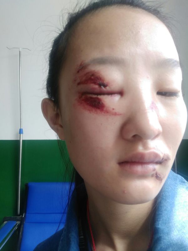 脸部受伤多久可以完全恢复?