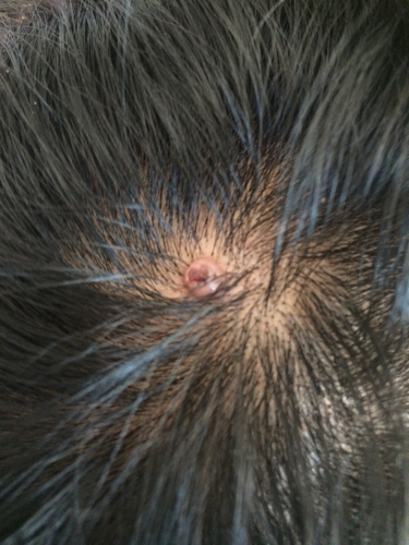 头顶脂肪瘤图片