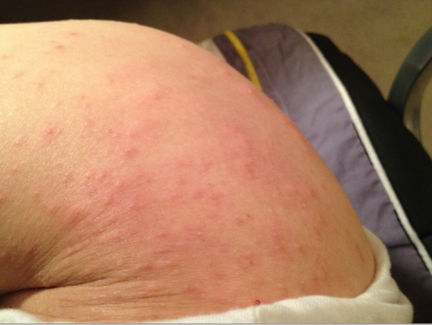 请问我这属于哪种皮肤病?股癣吗?还是只是单纯的过敏或者热出来的?