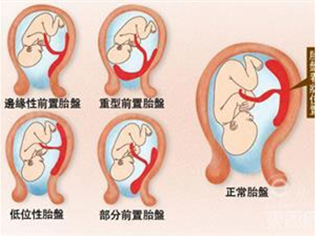 前置胎盘的分类