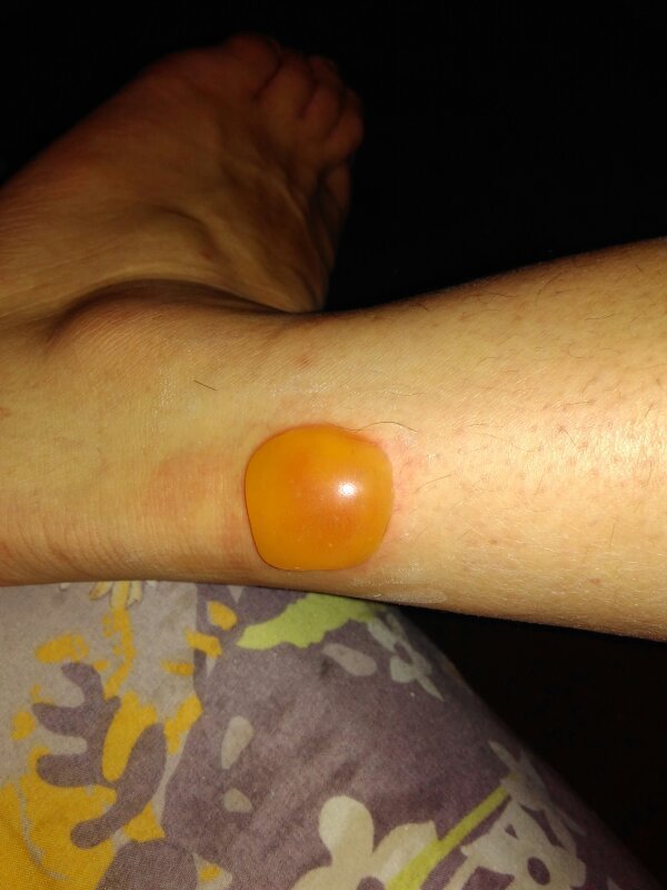 脚背被热水袋给烫了个大泡,然后我等了几天,就用针把水泡给挑了,请问