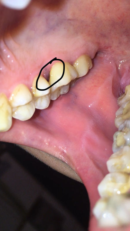 正常牙龈内部图片图片