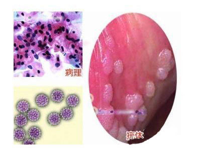 疾病常识:花柳病具体包括哪几种病