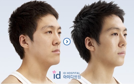 男性隆鼻选择假体隆鼻