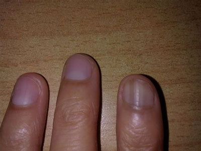 指甲上有竖纹是不是表示肝脏不好?