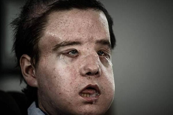 男子接受换脸手术_男子经历两次"换脸"手术,成为世界第一个"三面人"