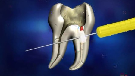 达雅鼎 韩国 diadent  热牙胶充填系统