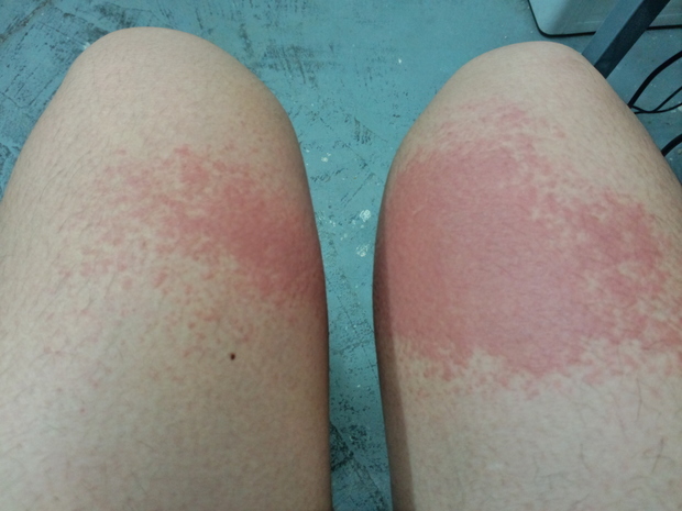 前段时间漂流后皮肤晒伤,擦了几种药膏后,有过