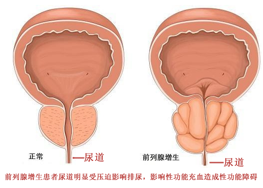前列腺肿大图片外表图片