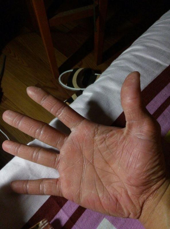 手角质很厚又干又糙,手背手纹深很皱,怎么办19岁男想和女生牵个手都不