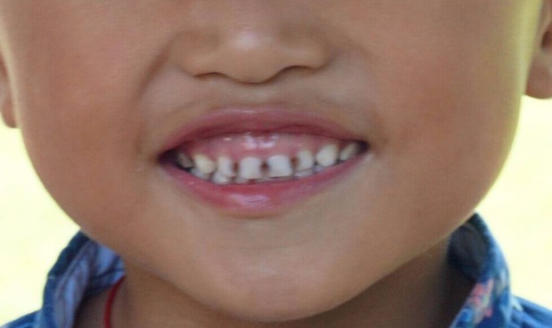 四岁男宝门牙缝发黑,大牙齿里面发黑了,要怎么补救?