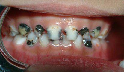 牙齿长虫子图片