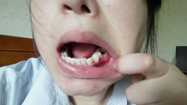 蛀牙了,还带有炎症,以前是鼓出一个肉包怎么也治不好,现在整个牙龈都