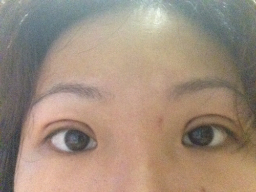 割双眼皮 拆线两天了 什么时候可以沾水 什么时