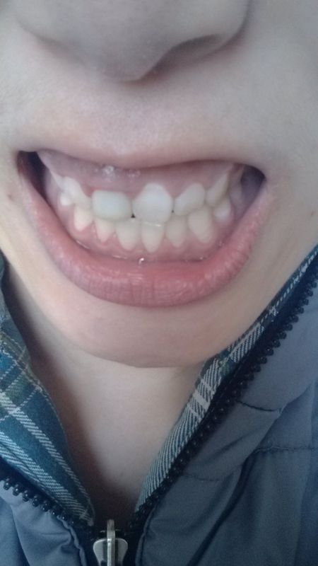 右边门牙是烤瓷的,左边的牙龈不知什么时候比右边高出好多,下边的牙龈