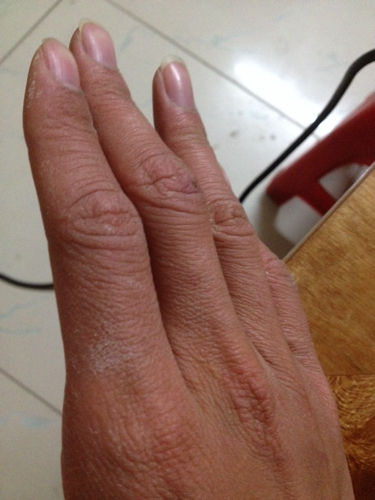 我的皮肤到冬天就开裂,龟裂,粗糙起皮干燥爆裂出血!