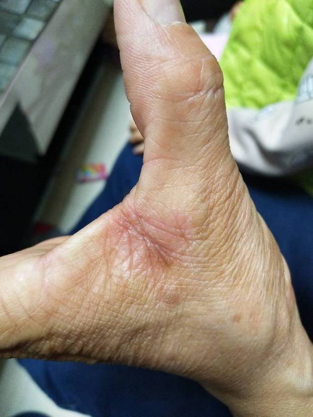 过敏体质手痒,有两年了,最近严重了,在医院查过过敏源说蘑菇和屋尘