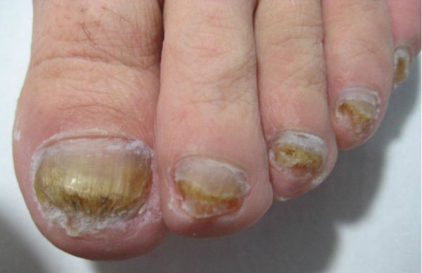 真菌感染型灰指甲的成因