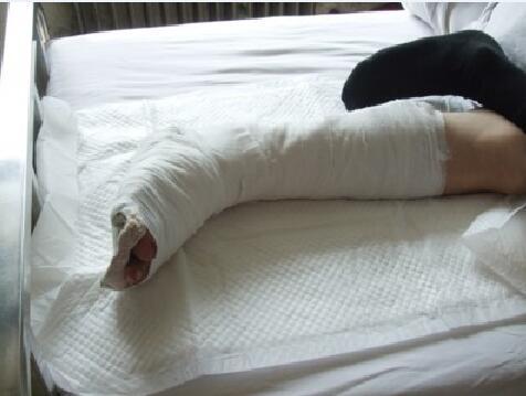 崴脚了医生说这是粉碎性骨折,请看片子,我怎么