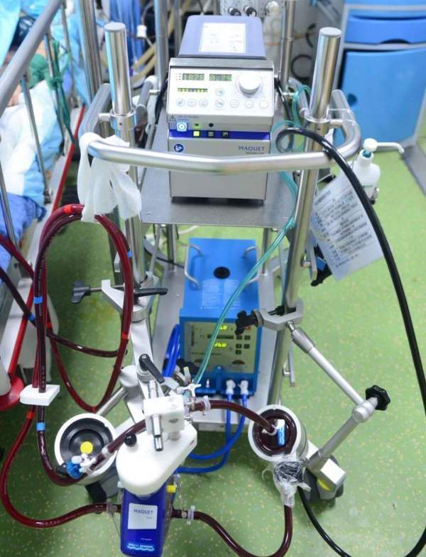 人工心肺机简称是什么英文字母?