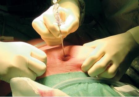 针刺肚脐过程图片