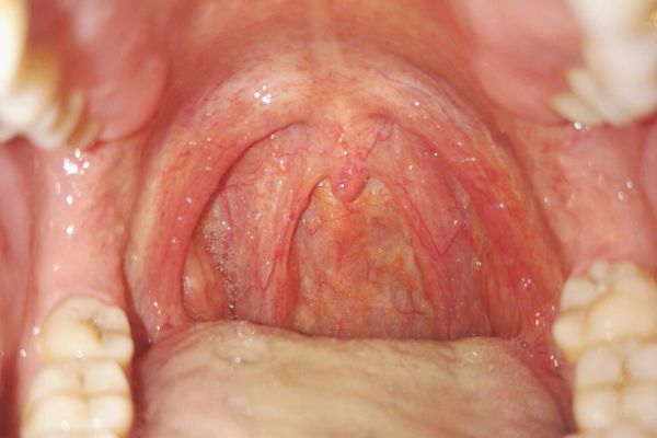 正常的喉咙里面图片图片