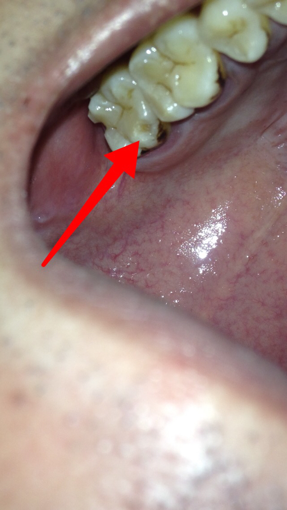 这牙齿缺了一块,是蛀牙吗?被牙虫吃掉的吗?这